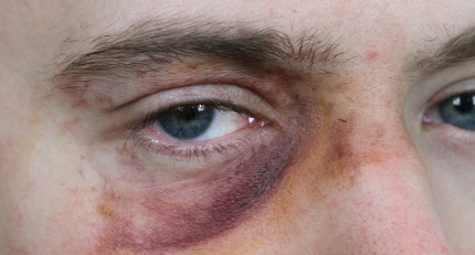 How high levels of uric acid in us could harm our eyesight or vision?