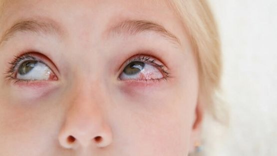Eye Infection: Symptoms, Causes, Treatment & Prevention