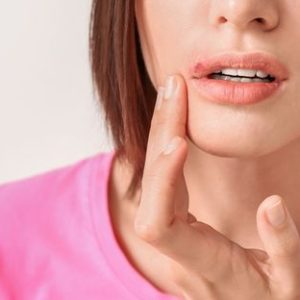 What Are Cold Sores? Symptoms, Causes & Treatment