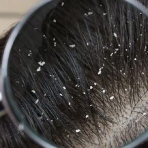 Home Remedies to Get Rid of Dandruff Naturally