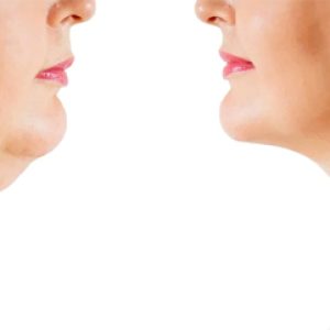 How to Reduce Face Fat Naturally